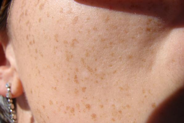 Knowledge Is Cure; Know About Skin Cancer Symptoms And Get Rid Of Ignorance!