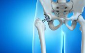 Hip Arthroscopy Vs Total Hip Replacement Procedure and Benefits