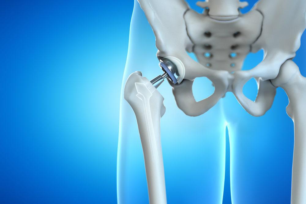 Hip Arthroscopy Vs Total Hip Replacement Procedure and Benefits