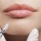Lip Enhancement: What Is It and Why It is Important