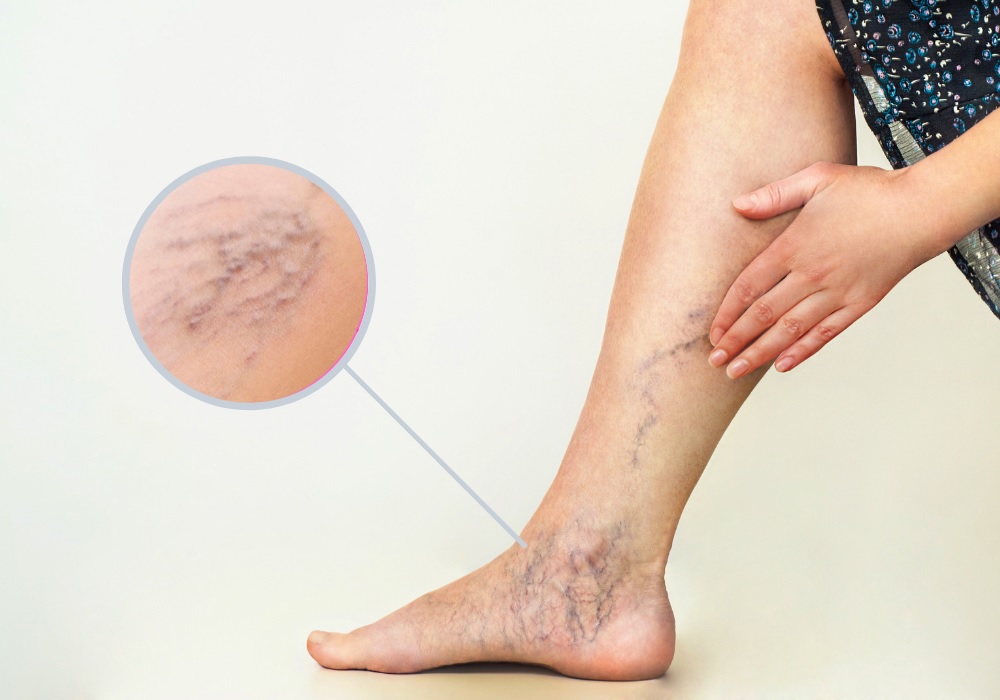 What are the benefits of nonsurgical procedures to Get Rid of Varicose Veins